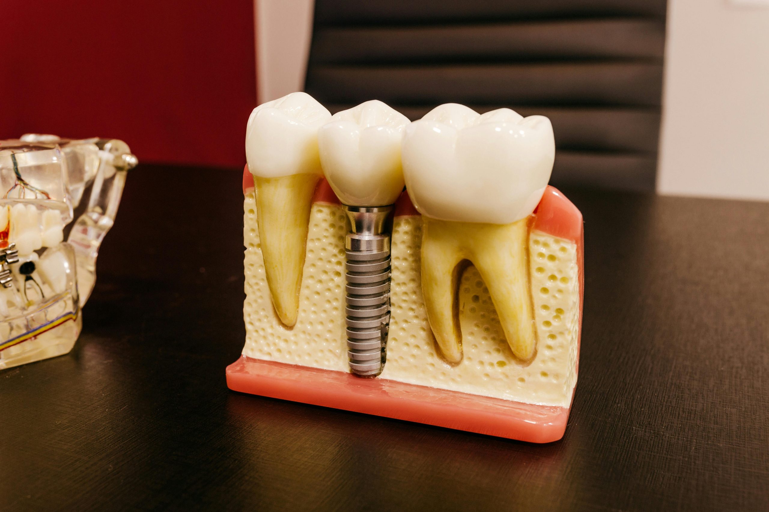 Implantes Dentales: Beneficios Estéticos y Funcionales para tu Sonrisa